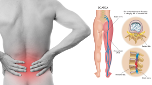 8 Sciatica Stretches That Prevent and Relieve Hip and Lower Back Pain